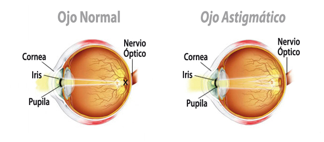 Astigmatismo