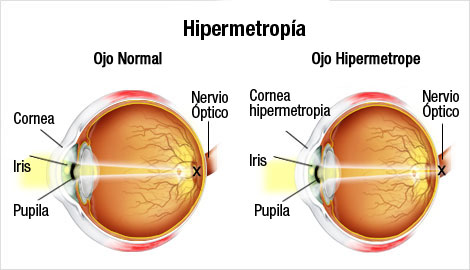 Hipermetropía