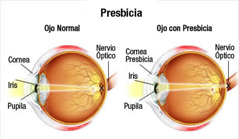 Presbicia